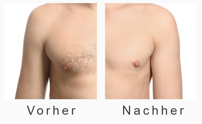 Vorher-Nachher-Foto - Laser-Haarentfernung an Brust Mann