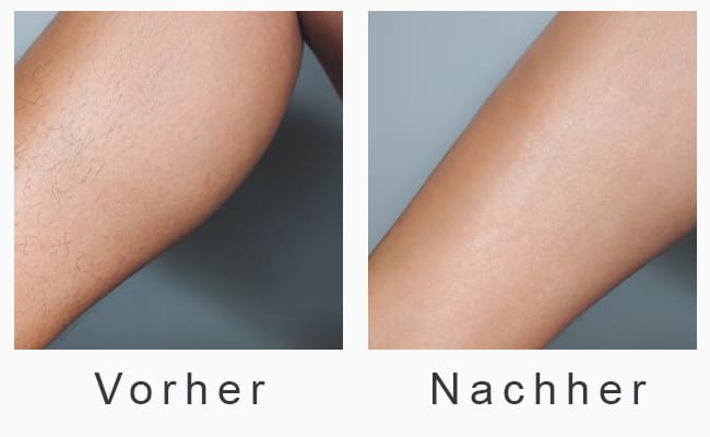 Vorher-Nachher-Foto - Laser-Haarentfernung an Beinen
